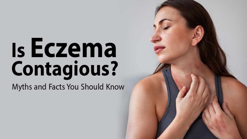 Common Myths About Eczema
